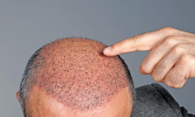 Пересадка волос в Турции Пересадка волос в Турции