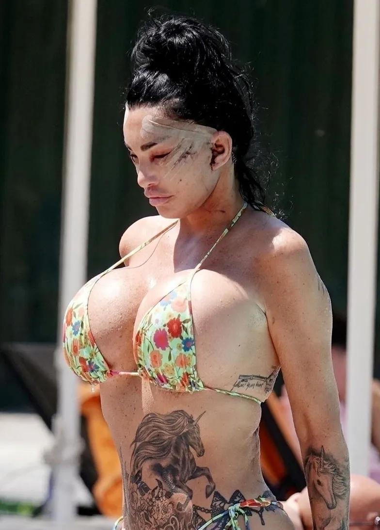 Кэти Прайс после операции